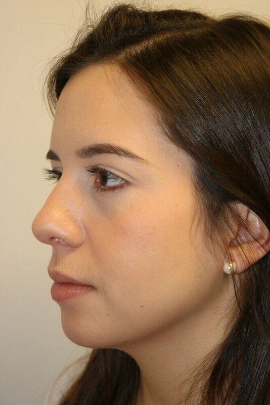 Rhinoplasty Before & After Image