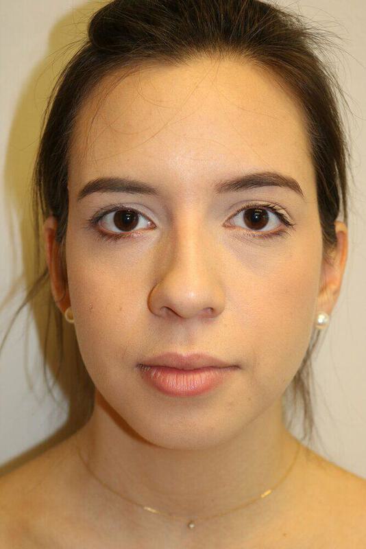 Rhinoplasty Before & After Image