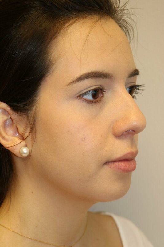 Rhinoplasty Before & After Image