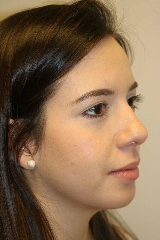 Rhinoplasty Before & After Image