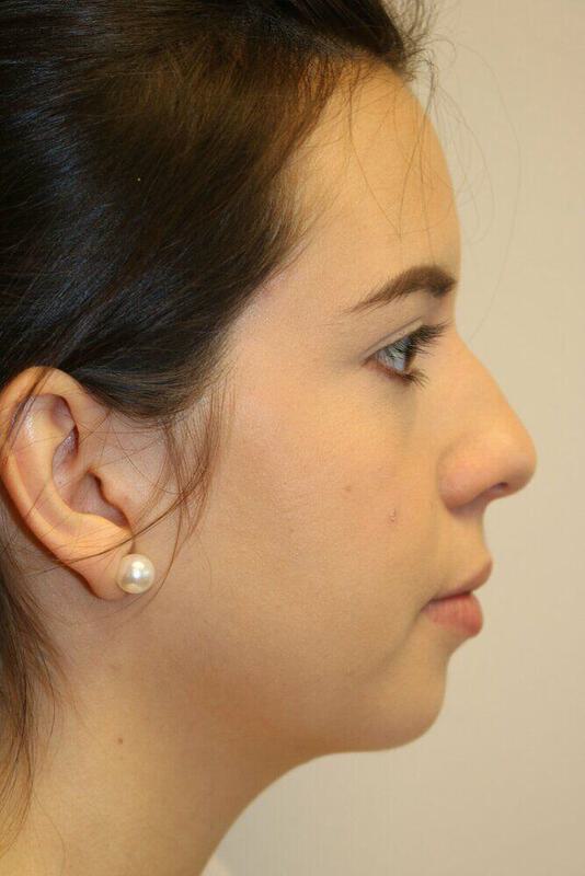 Rhinoplasty Before & After Image