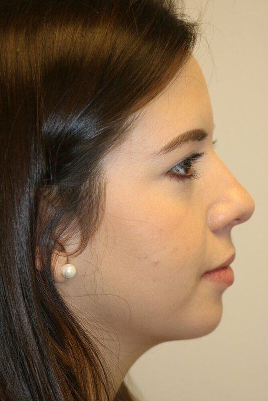 Rhinoplasty Before & After Image