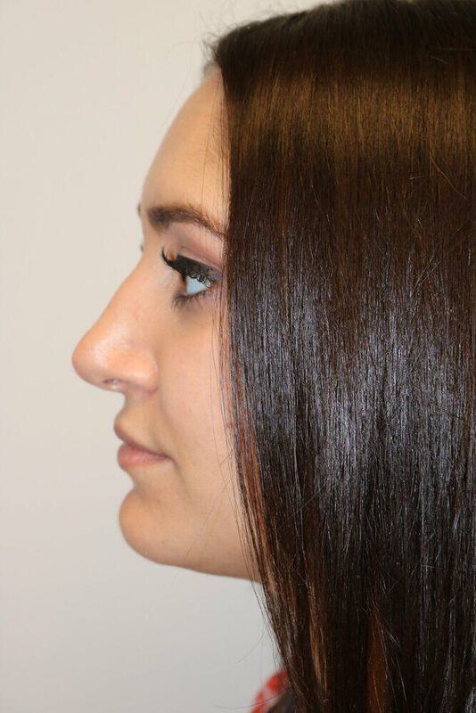 Rhinoplasty Before and After 08 | ARC Plastic Surgery
