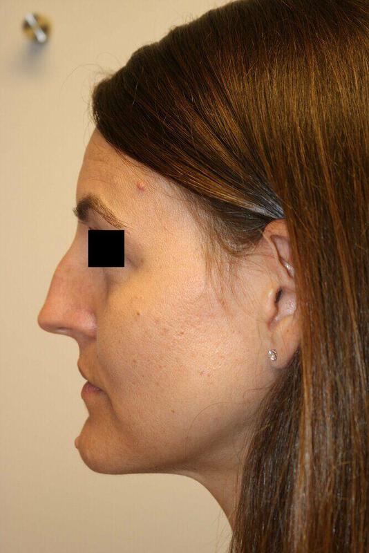 Rhinoplasty Before & After Image