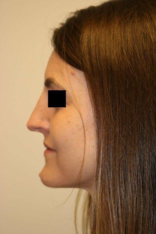 Rhinoplasty Before & After Image