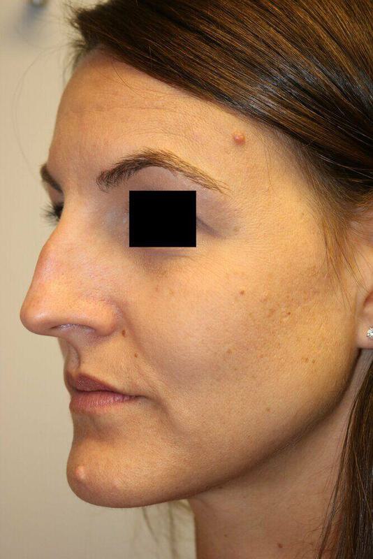 Rhinoplasty Before & After Image