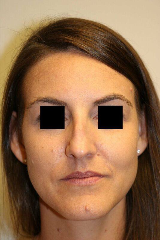 Rhinoplasty Before & After Image