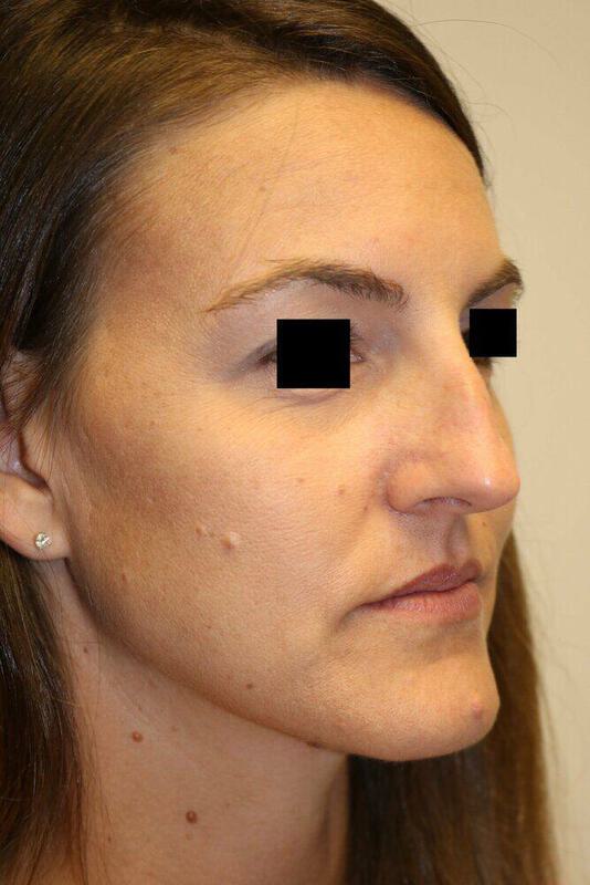 Rhinoplasty Before & After Image