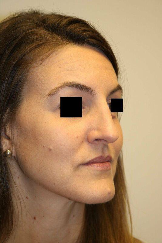 Rhinoplasty Before & After Image