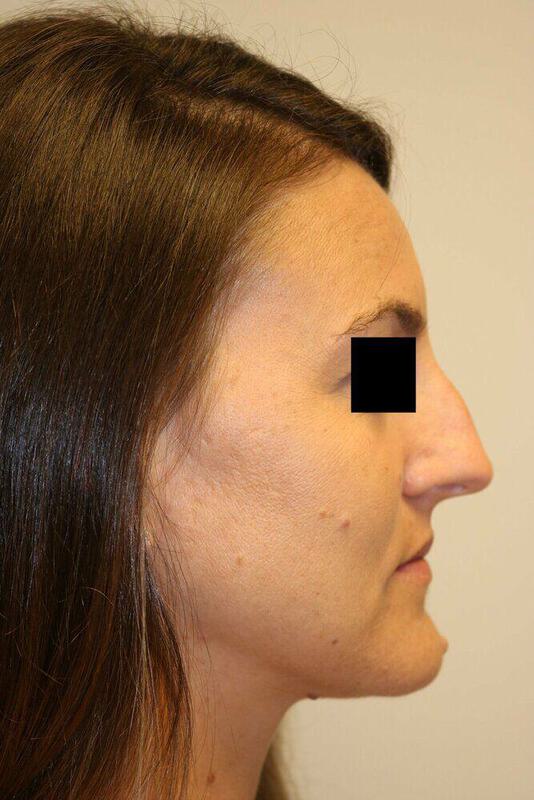 Rhinoplasty Before & After Image