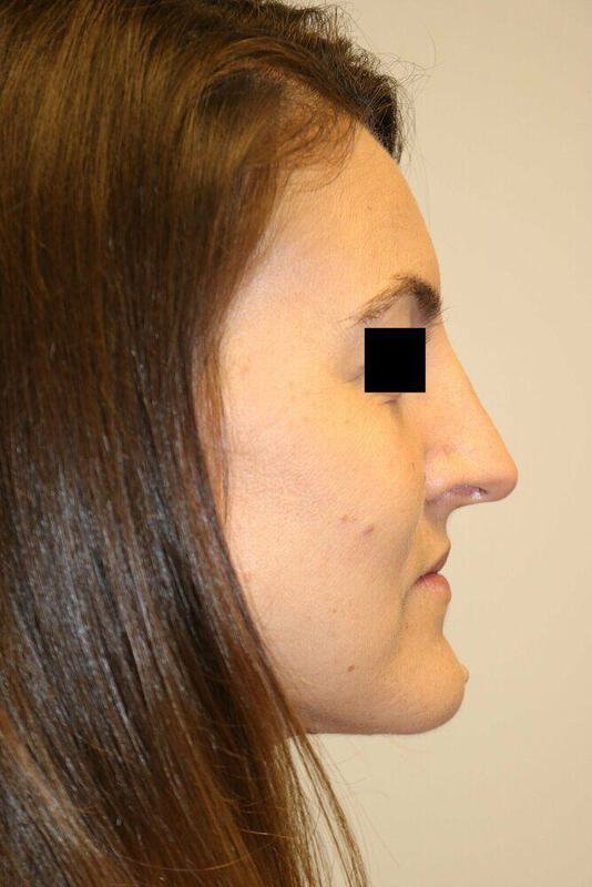 Rhinoplasty Before & After Image