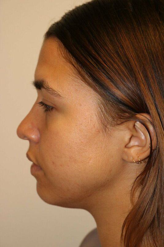 Rhinoplasty Before & After Image