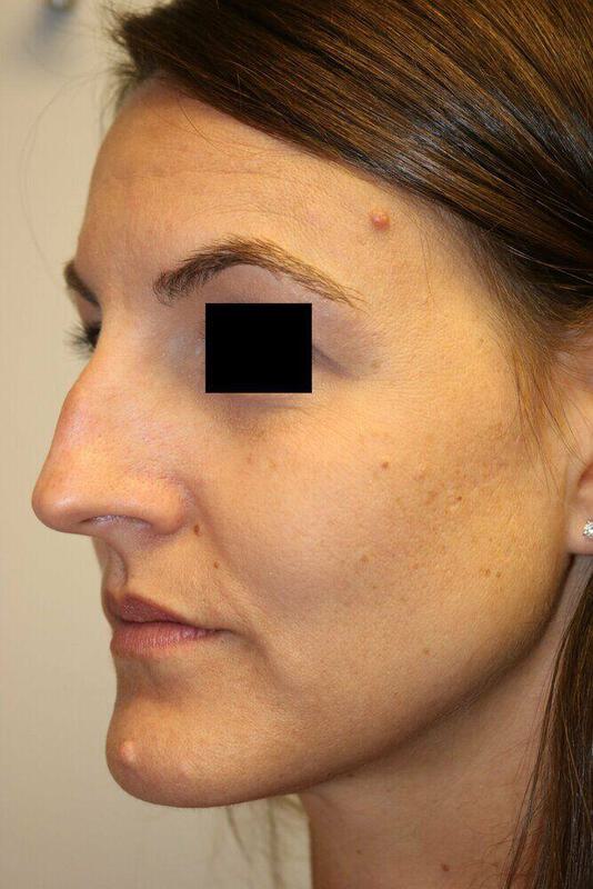 Rhinoplasty Before and After 10 | ARC Plastic Surgery