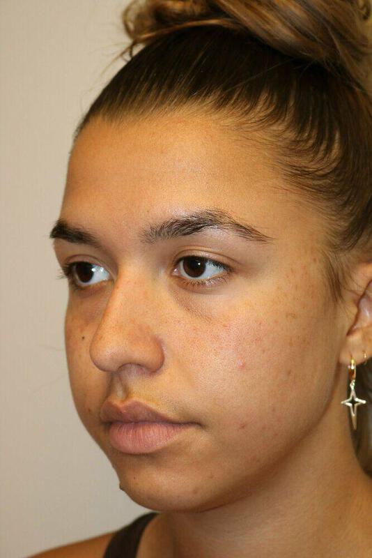 Rhinoplasty Before & After Image