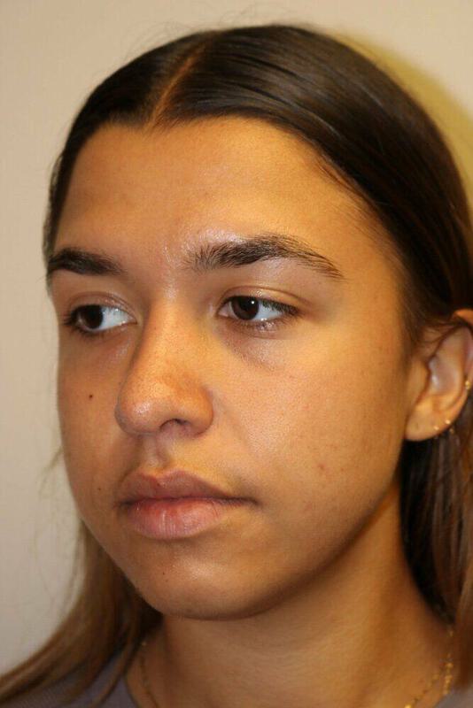 Rhinoplasty Before & After Image