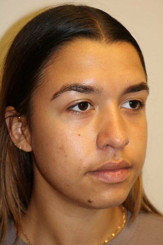 Rhinoplasty Before & After Image