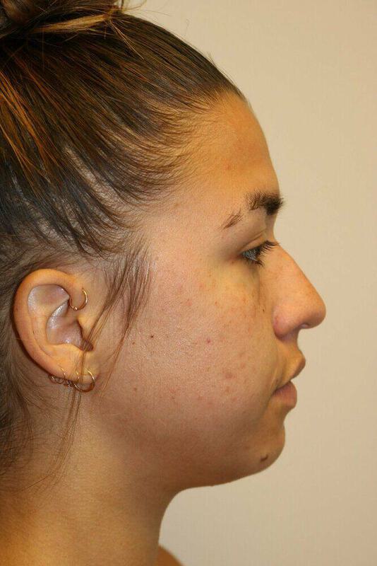 Rhinoplasty Before & After Image