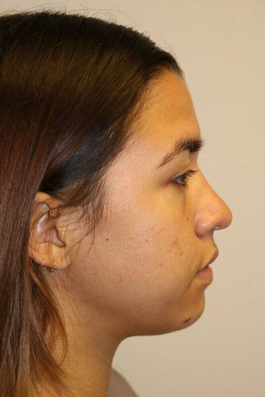 Rhinoplasty Before & After Image