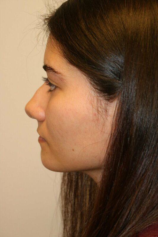 Rhinoplasty Before & After Image