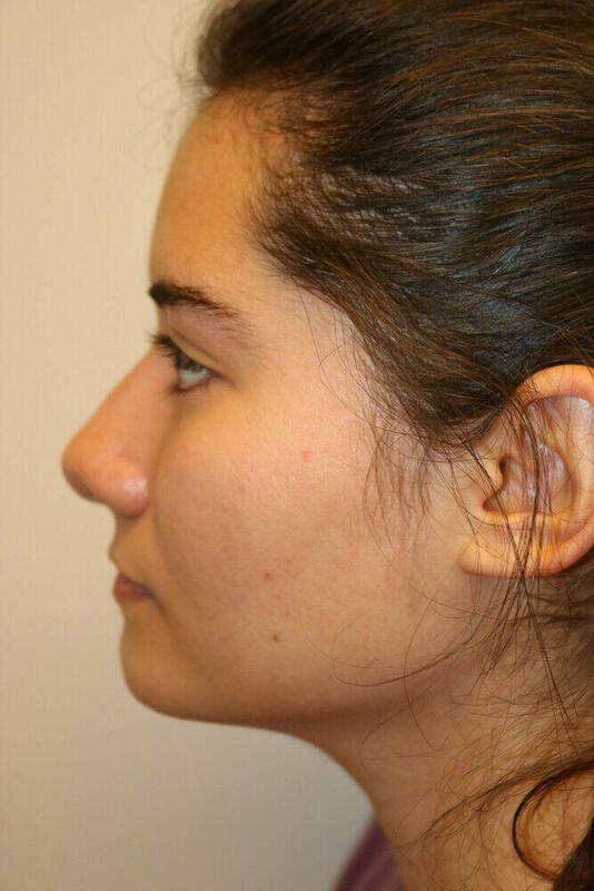 Rhinoplasty Before & After Image