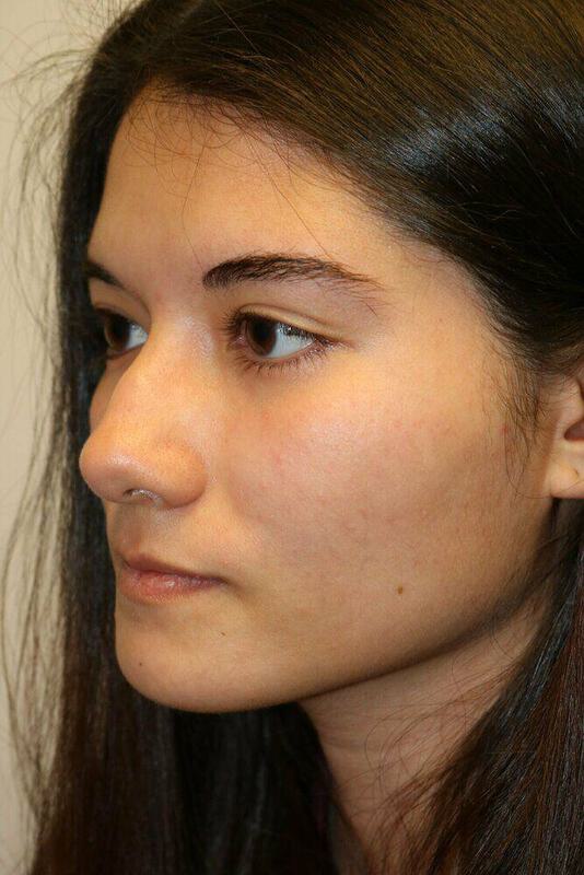 Rhinoplasty Before & After Image