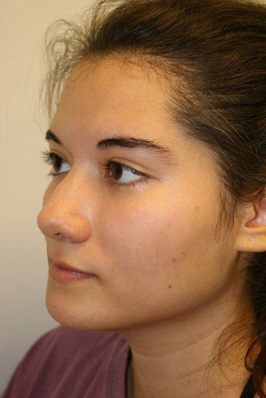 Rhinoplasty Before & After Image