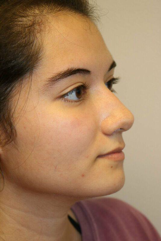 Rhinoplasty Before & After Image