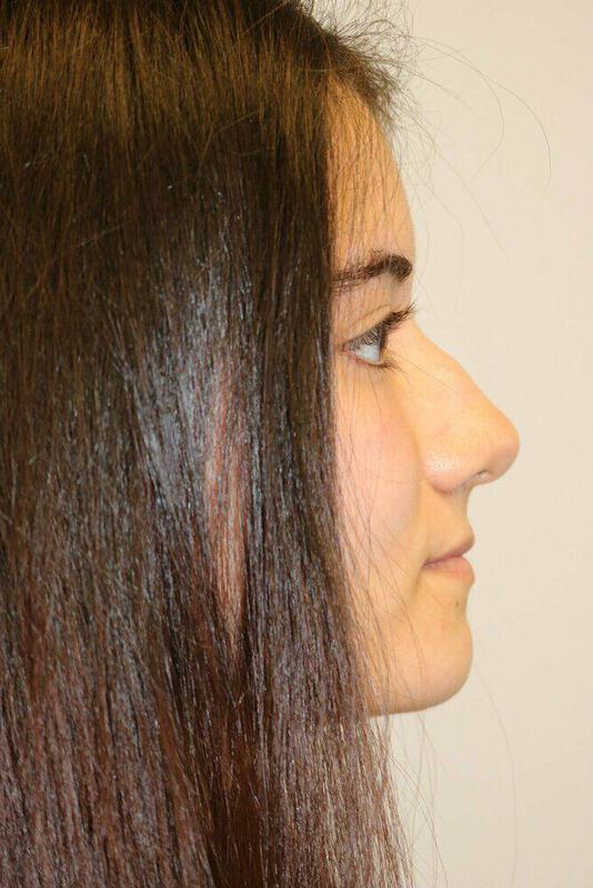 Rhinoplasty Before & After Image