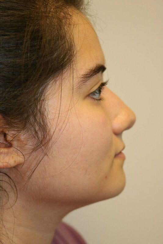 Rhinoplasty Before & After Image