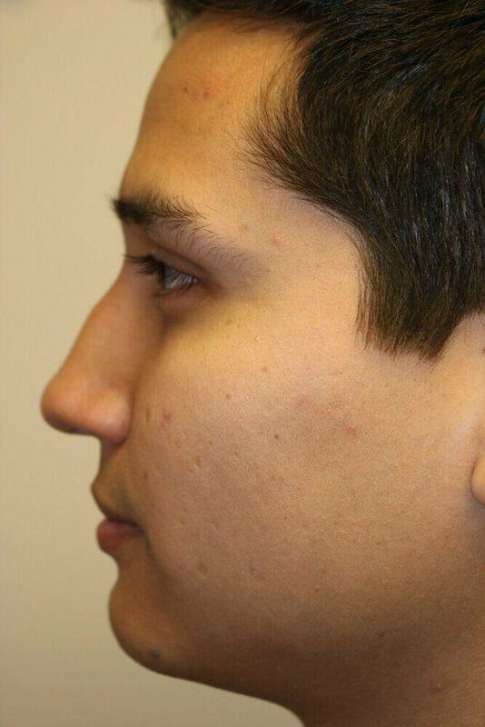 Rhinoplasty Before & After Image