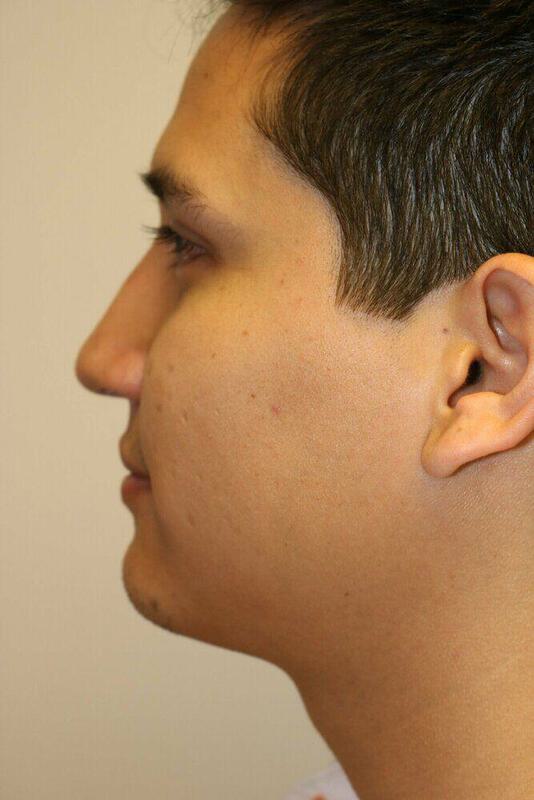 Rhinoplasty Before & After Image