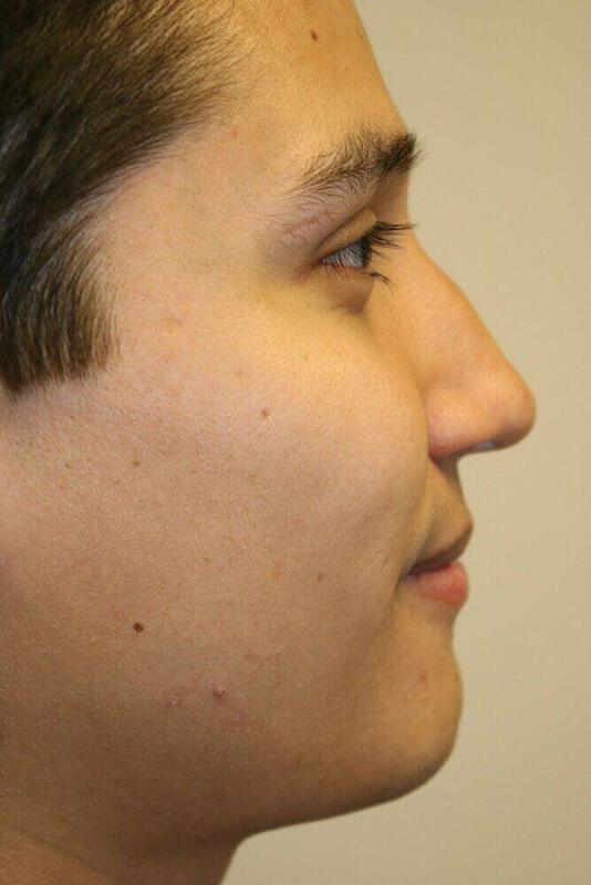 Rhinoplasty Before & After Image