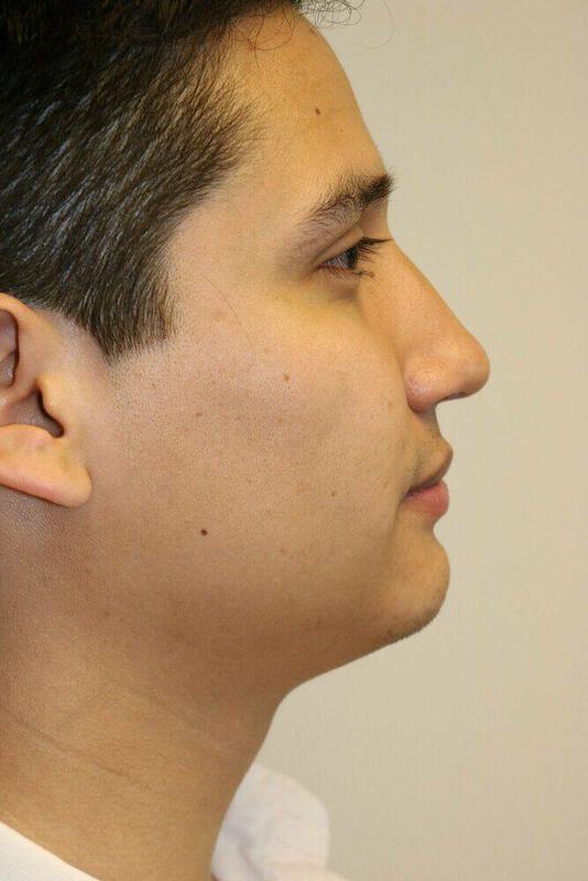 Rhinoplasty Before & After Image