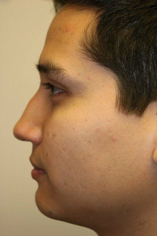 Rhinoplasty Before and After 04 | ARC Plastic Surgery