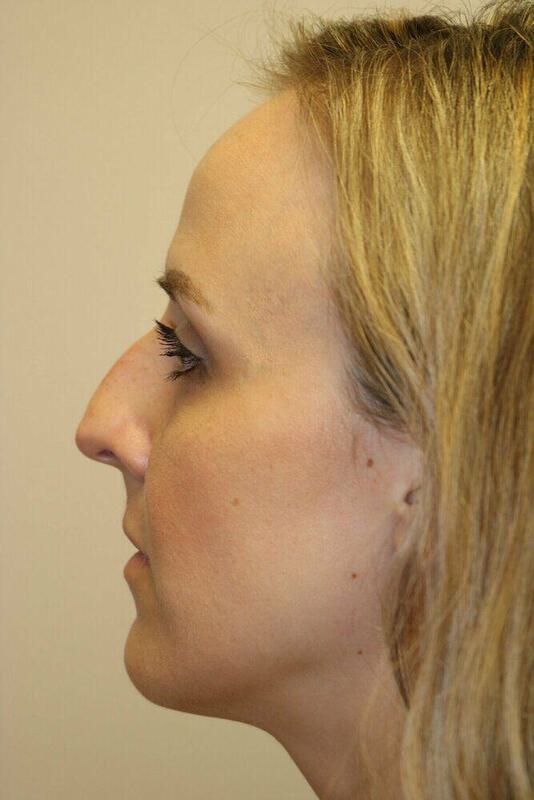 Rhinoplasty Before & After Image