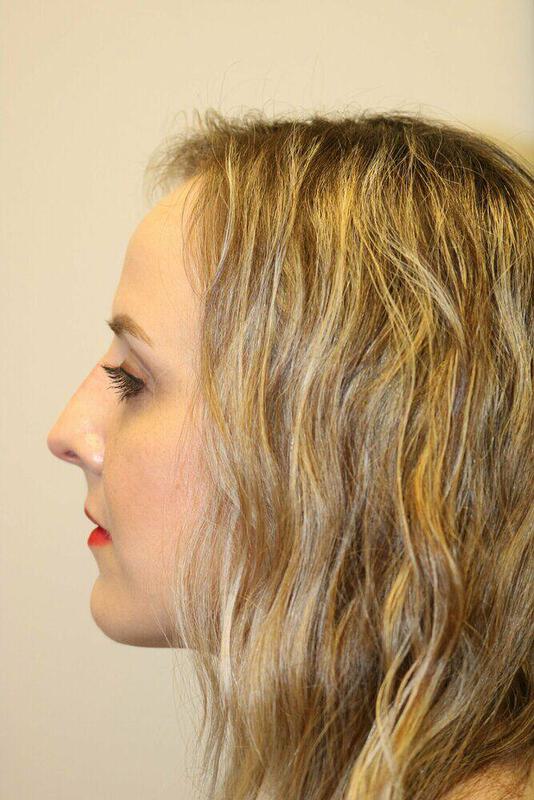 Rhinoplasty Before & After Image