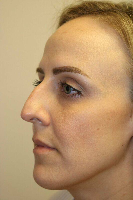 Rhinoplasty Before & After Image