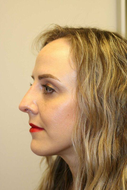 Rhinoplasty Before & After Image