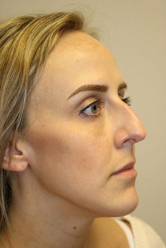 Rhinoplasty Before & After Image