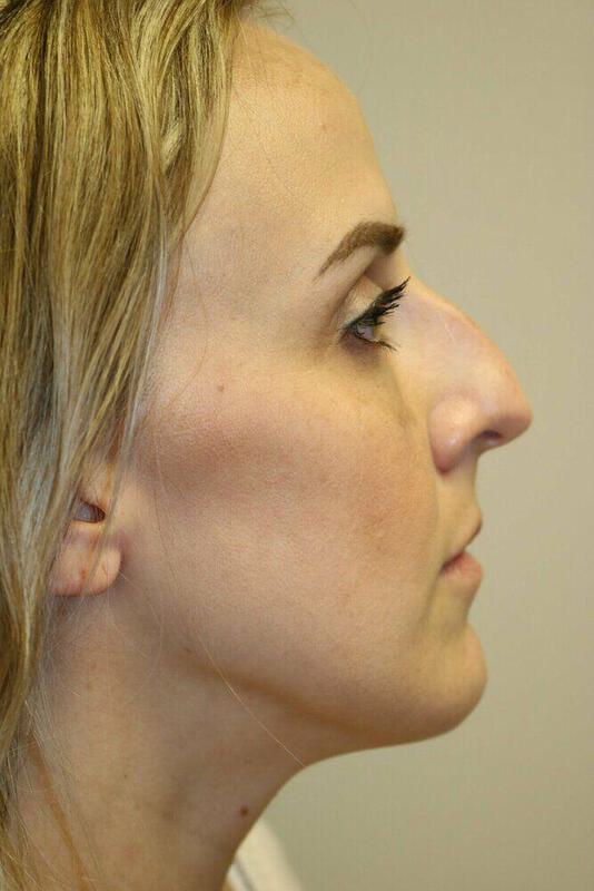 Rhinoplasty Before & After Image