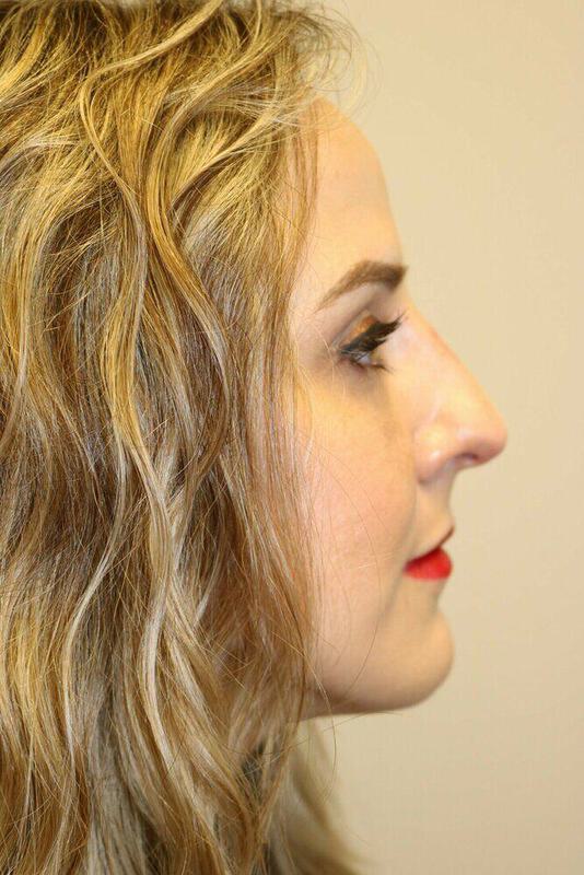 Rhinoplasty Before & After Image