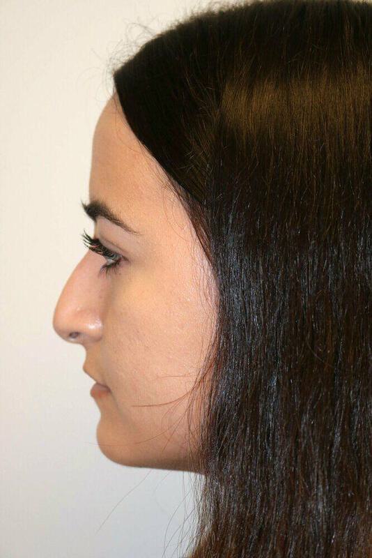 Rhinoplasty Before & After Image