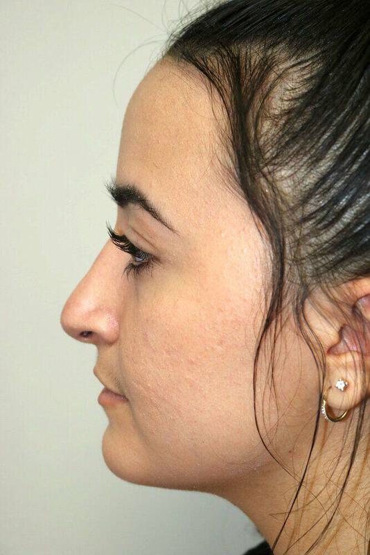 Rhinoplasty Before & After Image