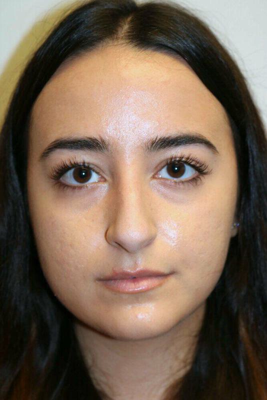 Rhinoplasty Before & After Image