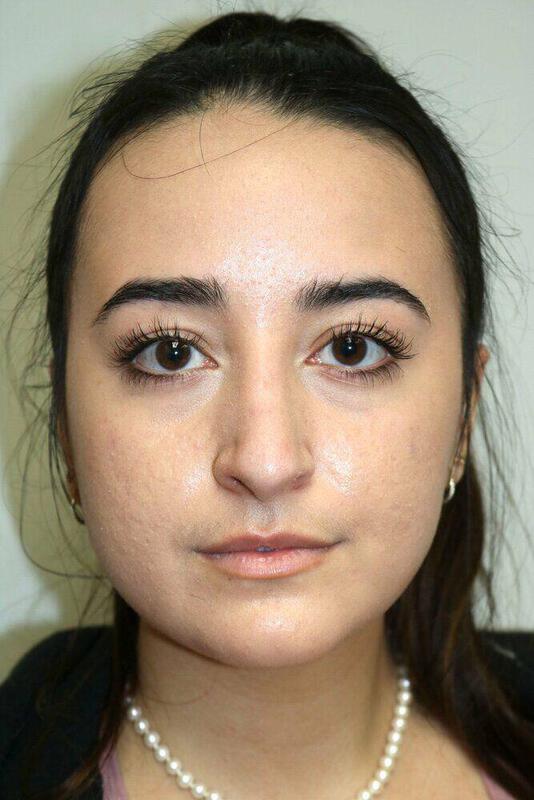 Rhinoplasty Before & After Image