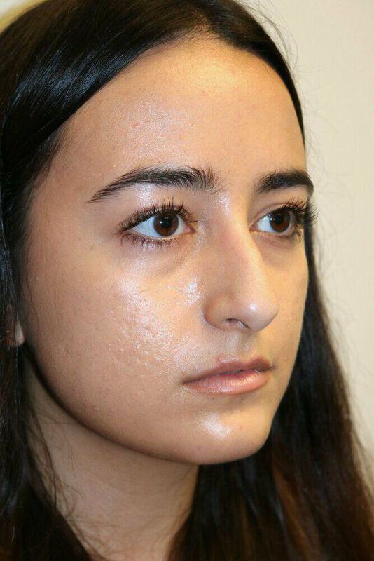 Rhinoplasty Before & After Image