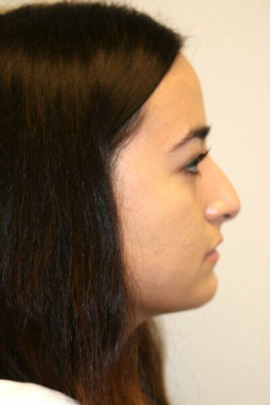 Rhinoplasty Before & After Image