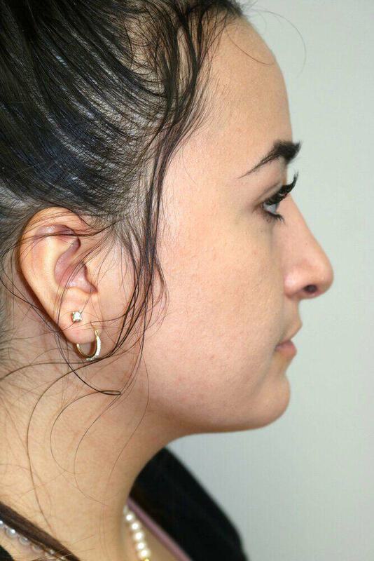 Rhinoplasty Before & After Image