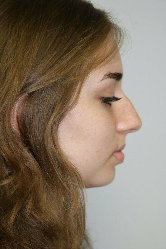 Rhinoplasty Before & After Image