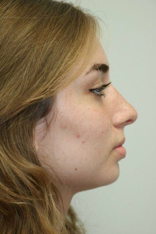 Rhinoplasty Before & After Image